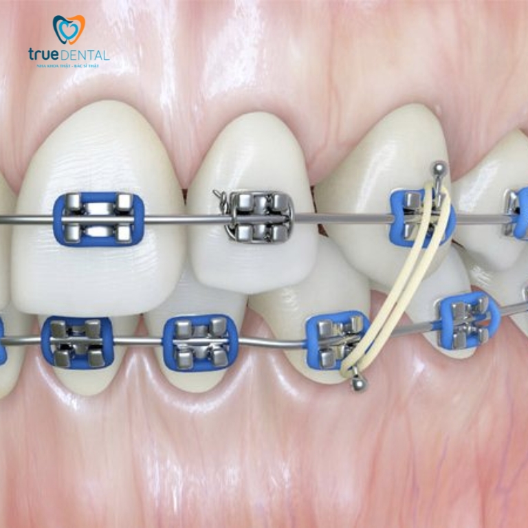 Nguyên nhân làm dây thun niềng răng bị vàng và cách xử lý 1 Dây thun niềng răng là gì?