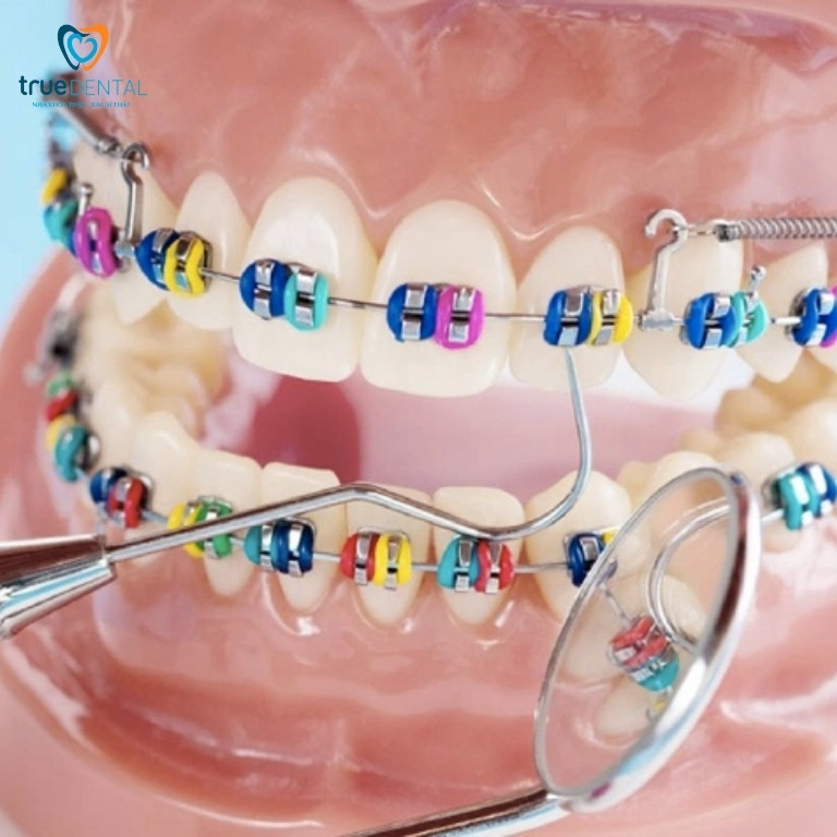 Nguyên nhân làm dây thun niềng răng bị vàng và cách xử lý 5 Chọn loại dây thun tối màu