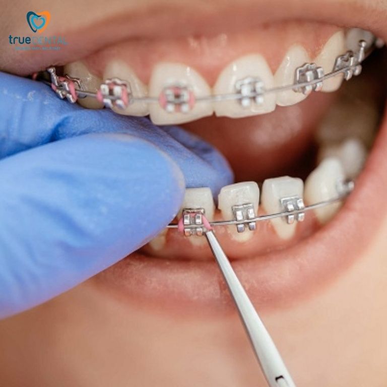 Nguyên nhân làm dây thun niềng răng bị vàng và cách xử lý 4 Cách xử lý khi dây thun niềng răng bị vàng