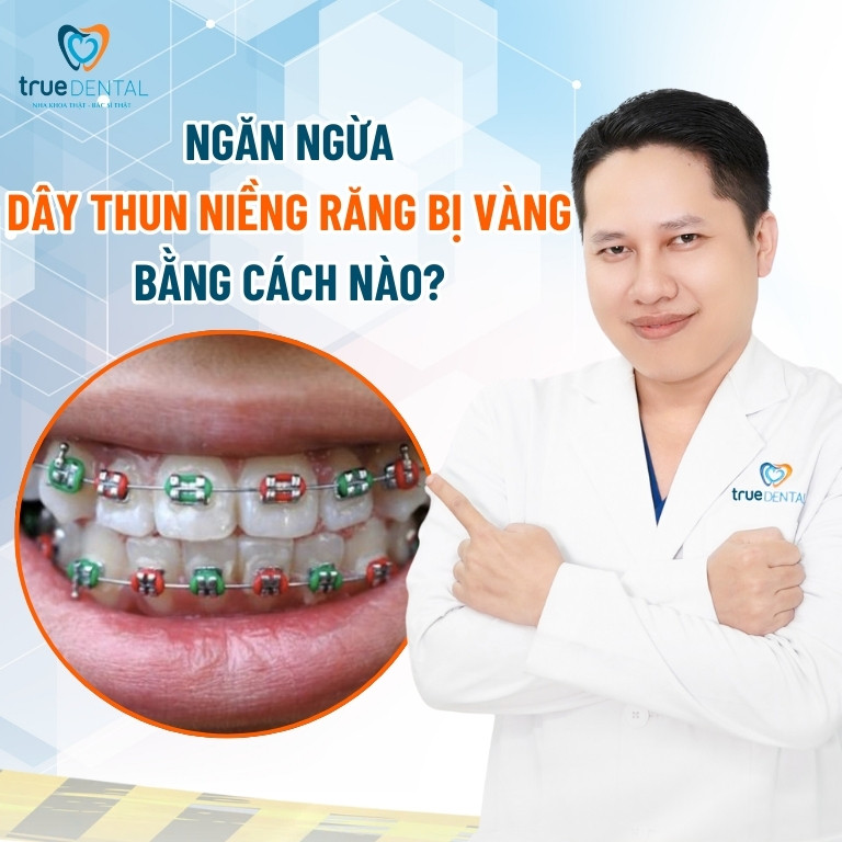 Nguyên nhân làm dây thun niềng răng bị vàng và cách xử lý 6 Cách ngăn ngừa dây thun niềng răng bị vàng