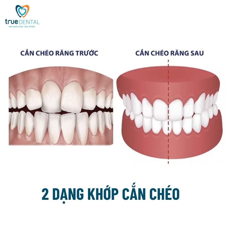 Khớp cắn chéo: Đặc điểm và cách chữa trị 1 Khớp cắn chéo là gì?