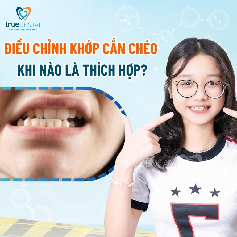 Khớp cắn chéo: Đặc điểm và cách chữa trị 5 Điều chỉnh khớp răng cắn chéo khi nào là thích hợp nhất?