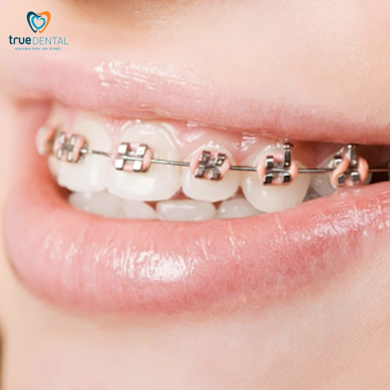Niềng răng mắc cài kim loại buộc chun là gì? Ưu và nhược điểm 1 Niềng răng mắc cài kim loại buộc chun là gì?