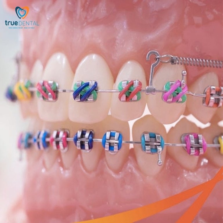 Niềng răng mắc cài kim loại buộc chun là gì? Ưu và nhược điểm 2 Cơ chế hoạt động của mắc cài kim loại buộc chun
