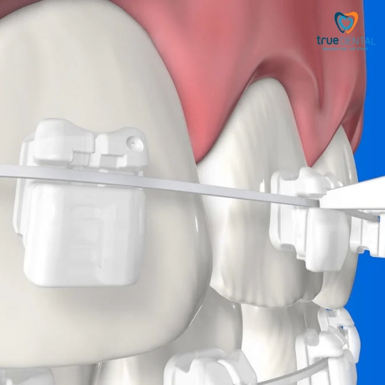 Từ A-Z Về Mắc Cài Tự Động: Chọn Sao Cho Đúng? 3 Mắc cài sứ tự động