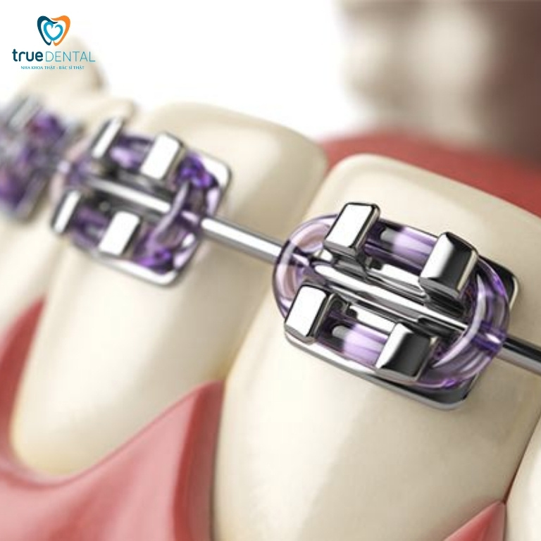 Ưu và nhược điểm của mắc cài thường là gì? Có nên dùng không? 2 Thế nào là niềng răng mắc cài thường?