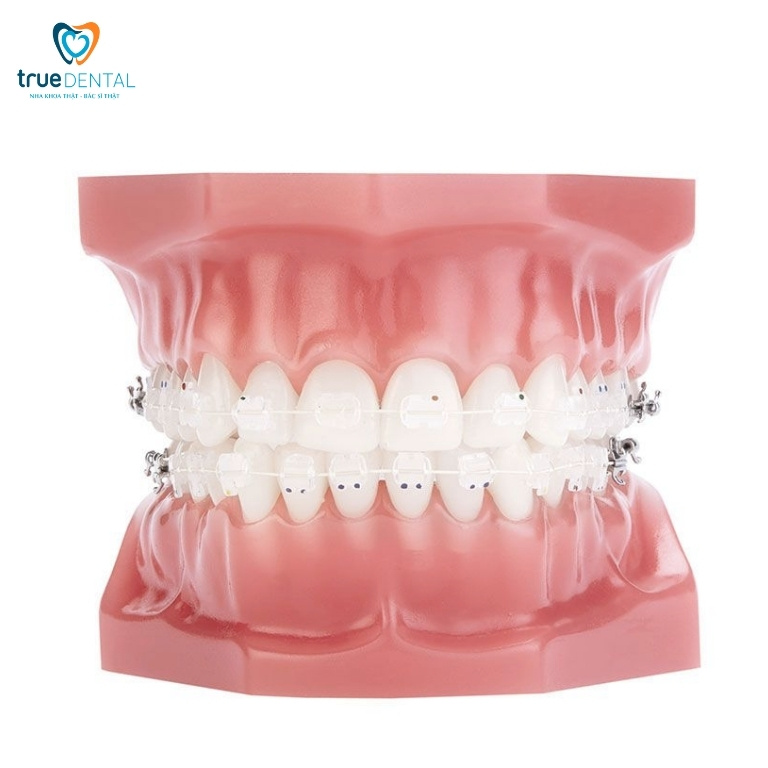 Niềng răng bao nhiêu tiền? Bảng giá niềng mới nhất 2025 2 Giá niềng răng mắc cài sứ