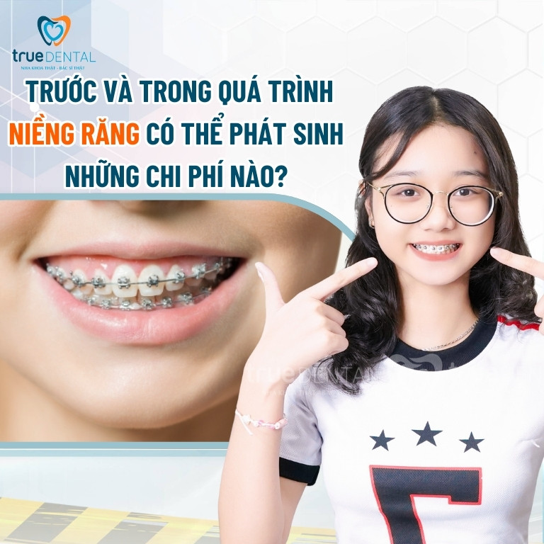 Niềng răng bao nhiêu tiền? Bảng giá niềng mới nhất 2025 7 Các chi phí có thể phát sinh trước và trong quá trình niềng răng