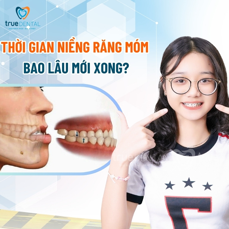 Niềng răng móm mất bao lâu thì xong? Chi phí ra sao? 5 Thời gian niềng răng móm mất bao lâu mới xong?
