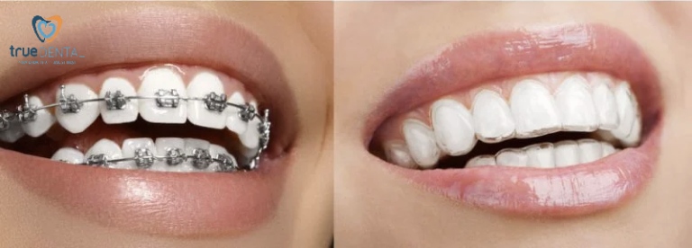 Niềng răng trong suốt có đau không? Giai đoạn nào đau nhất? 5 So sánh mức độ đau của niềng răng trong suốt với niềng răng mắc cài