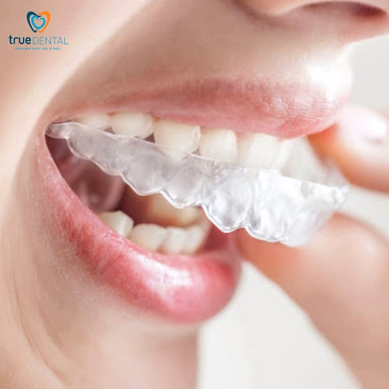 Niềng răng trong suốt có hiệu quả không? Ưu và nhược điểm 3 Linh hoạt, có thể tháo ra được