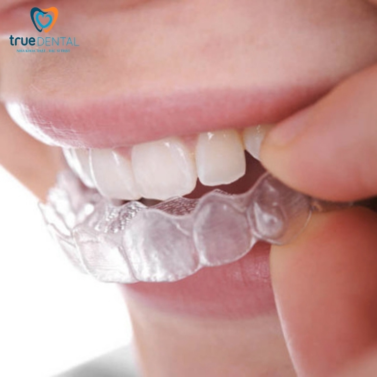 Niềng răng trong suốt có hiệu quả không? Ưu và nhược điểm 4 Yêu cầu tuân thủ nghiêm ngặt