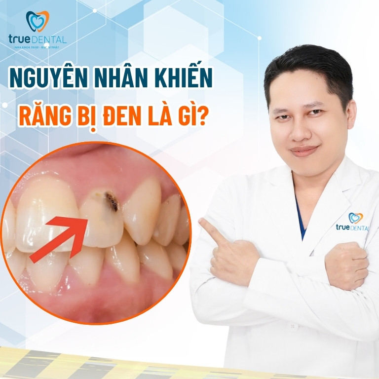 Răng bị đen: Nguyên nhân, cách chữa trị và phòng ngừa 2 Nguyên nhân khiến răng bị đen