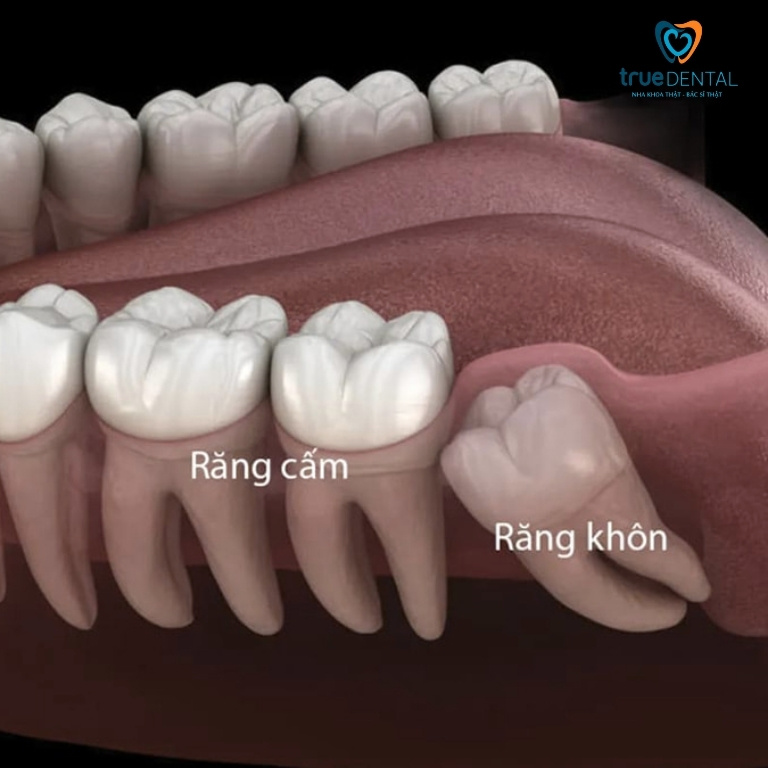 Răng cấm là răng số mấy? Có thay không? 4 Cách phân biệt răng cấm và răng khôn
