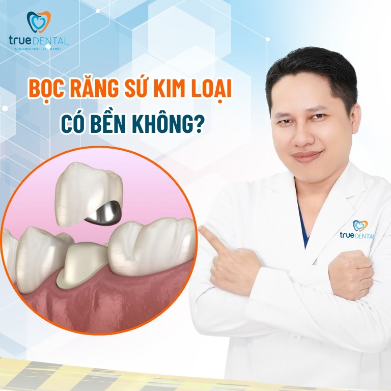 Răng sứ kim loại là gì? Có tốt không? 5 Bọc răng sứ kim loại có bền không?
