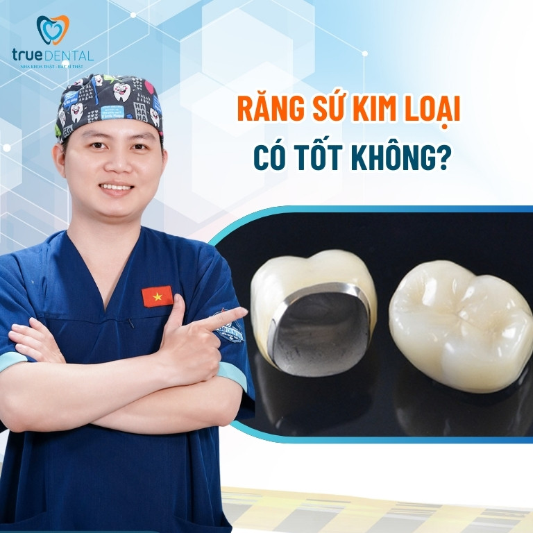 Răng sứ kim loại là gì? Có tốt không? 4 Răng sứ kim loại có tốt không?