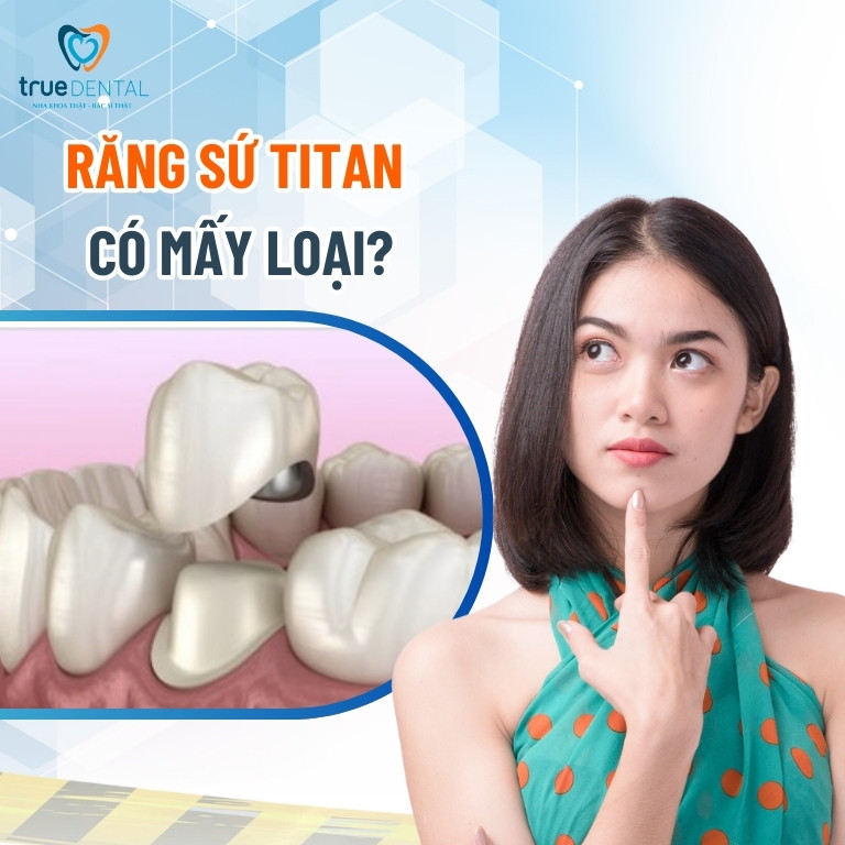 Răng sứ Titan là gì? Có tốt không? Giá bao nhiêu? 3 Răng sứ Titan có mấy loại?