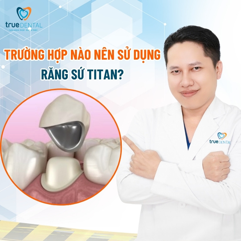 Răng sứ Titan là gì? Có tốt không? Giá bao nhiêu? 2 Trường hợp nào nên sử dụng răng sứ Titan?