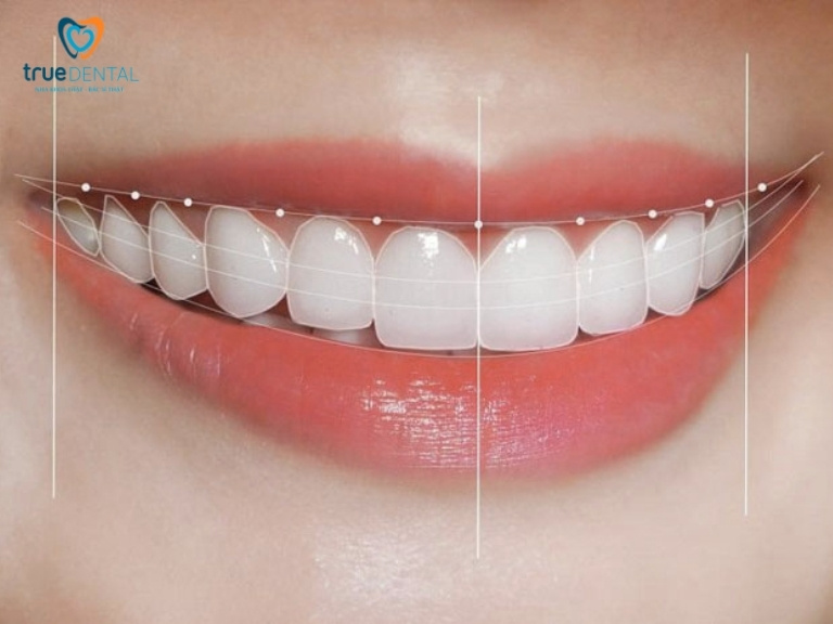 Răng thỏ là gì? Có nên làm răng sứ thỏ không? 1 Răng thỏ là gì?
