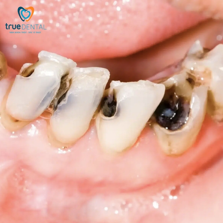 Răng có vết đen: Nguyên nhân, cách chữa trị và phòng ngừa 3 Răng bị đốm đen do sâu răng