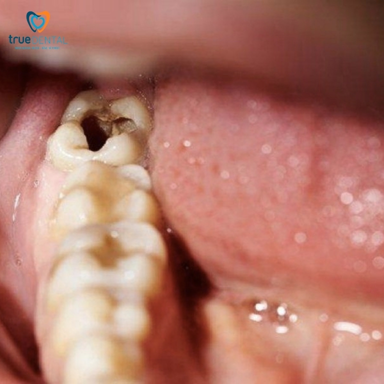 Trám răng sâu lỗ to được không? Giá bao nhiêu? 1 Răng sâu lỗ to là như thế nào?
