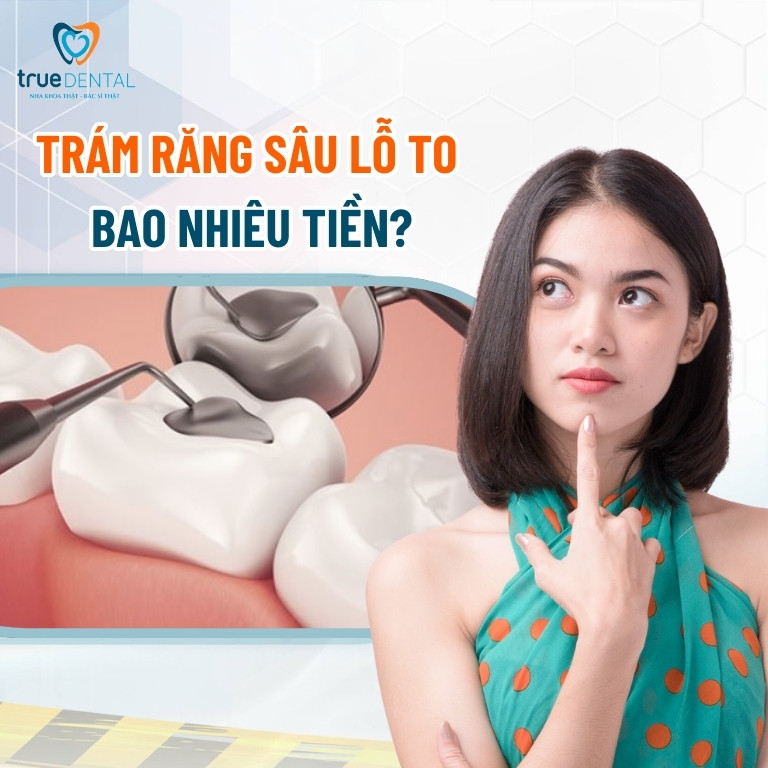 Trám răng sâu lỗ to được không? Giá bao nhiêu? 4 Trám răng sâu lỗ to bao nhiêu tiền?