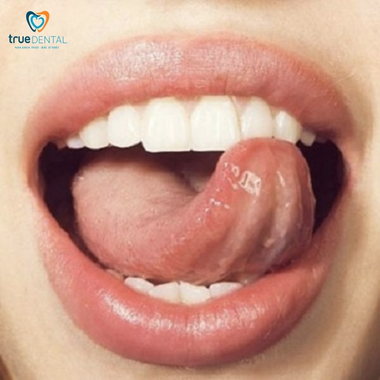 Trị móm tại nhà bằng cách nào? Có nên tự điều trị tại nhà không? 6 chữa món tại nhà
