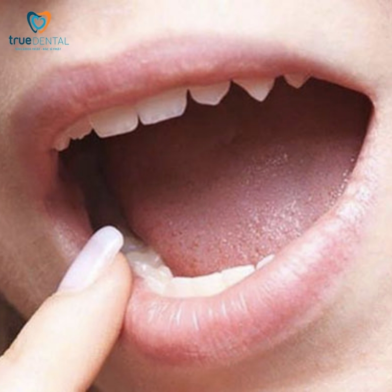 Trị móm tại nhà bằng cách nào? Có nên tự điều trị tại nhà không? 5 Một số cách trị móm tại nhà