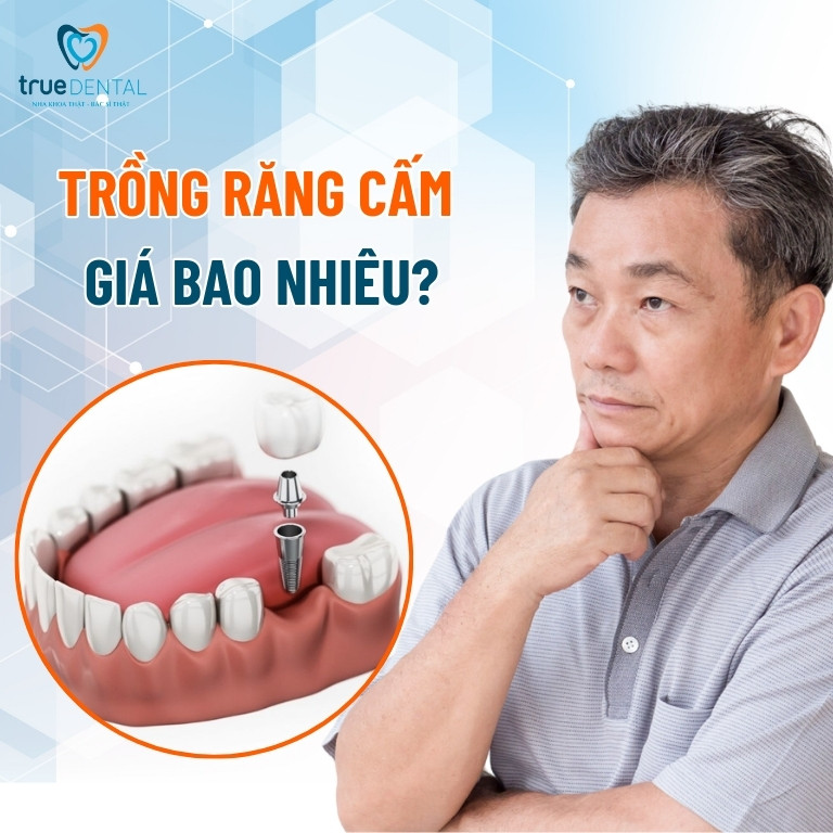 Trồng răng cấm giá bao nhiêu? Phương pháp nào hiệu quả 2 Trồng răng cấm giá bao nhiêu?