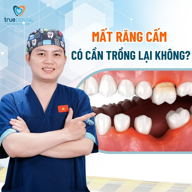 Trồng răng cấm giá bao nhiêu? Phương pháp nào hiệu quả 3 Mất răng cấm có cần trồng lại không?