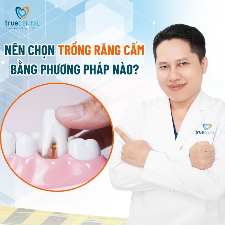 Trồng răng cấm giá bao nhiêu? Phương pháp nào hiệu quả 4 Nên chọn trồng răng cấm bằng phương pháp nào?
