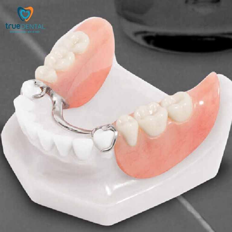 Trồng răng giả mất bao lâu để hoàn thành? 2 Hàm giả tháo lắp bán phần