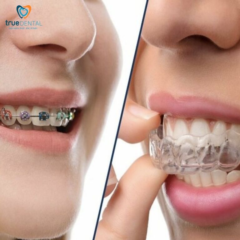 Tư vấn niềng răng - Thông tin giải đáp chi tiết từ Bác sĩ True Dental 1 Niềng răng là gì?