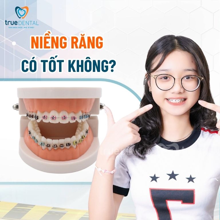 Tư vấn niềng răng - Thông tin giải đáp chi tiết từ Bác sĩ True Dental 2 Tư vấn niềng răng có tốt không?
