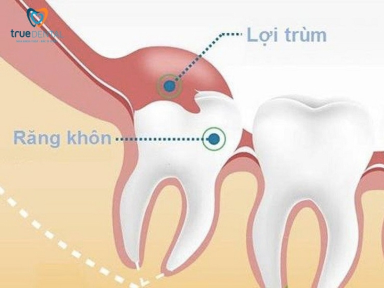 Viêm lợi trùm là gì? Có nguy hiểm không? 1 Viêm lợi trùm là gì?