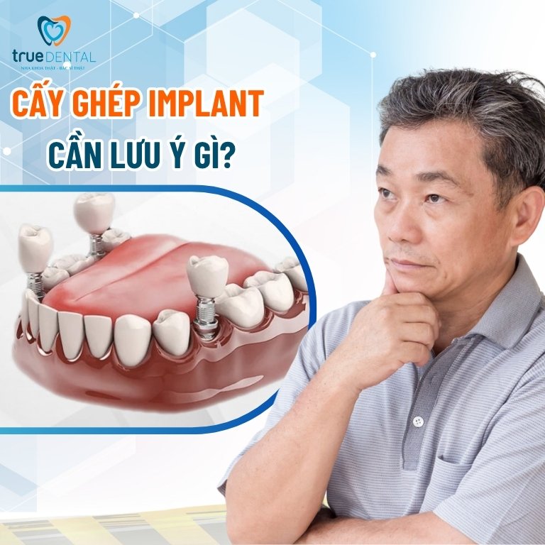 Các Loại Cấy Ghép Implant Và Cách Lựa Chọn Đúng Dành Cho Bạn 12 Cấy ghép Implant cần lưu ý gì?