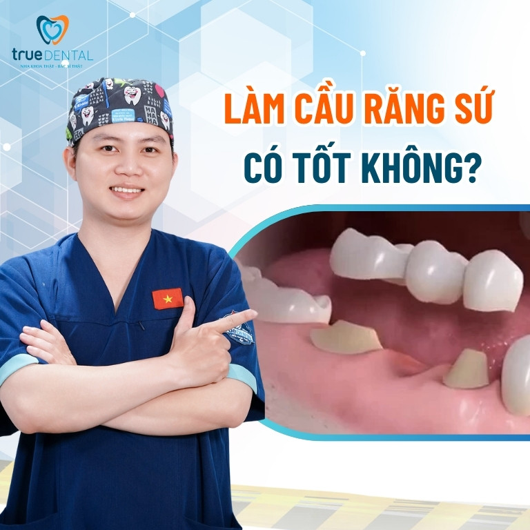 Cầu răng sứ là gì? Làm cầu răng sứ có bền không? 7 Làm cầu răng sứ có tốt không?