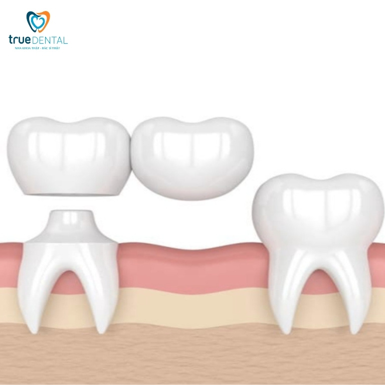 Cầu răng sứ là gì? Làm cầu răng sứ có bền không? 4 Cầu răng sứ nhảy