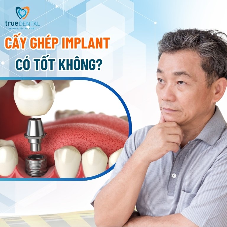 Cấy Ghép Implant Có Tốt Không? Sự Thật Không Phải Ai Cũng Biết 2 Cấy ghép Implant có tốt không?