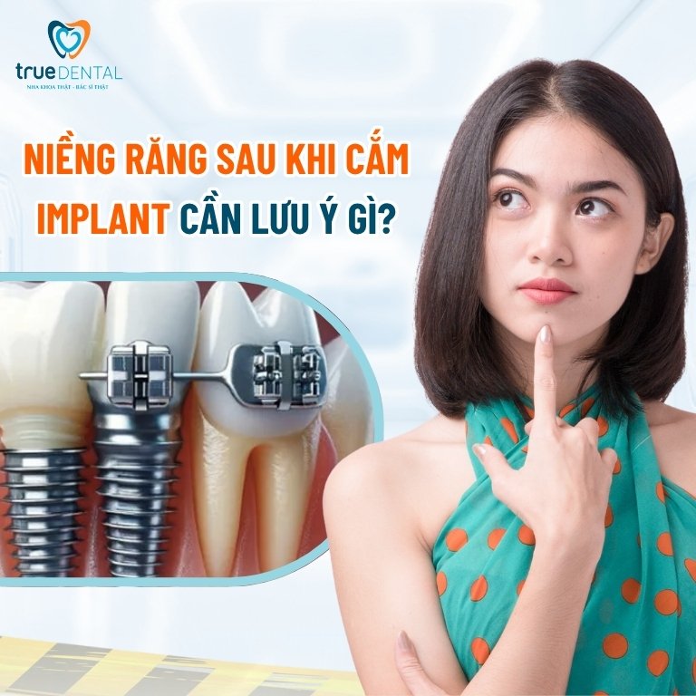 Cấy Ghép Implant Và Niềng Răng: Có Làm Cùng Lúc Được Không? 5 Những lưu ý khi thực hiện niềng răng sau khi cắm implant