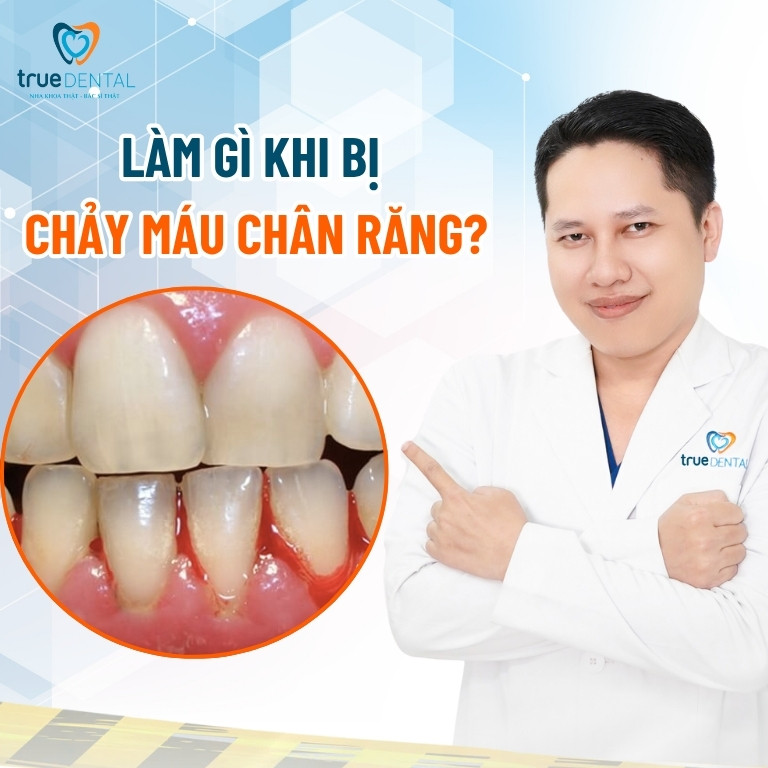 Chảy máu chân răng nguyên nhân do đâu? Chữa bằng cách nào? 4 Làm gì khi bị chảy máu chân răng?