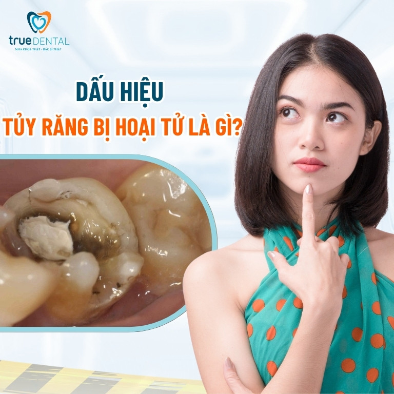 Hoại tử tủy răng: Nguyên nhân, dấu hiệu và cách điều trị 5 Dấu hiệu tủy răng bị hoại tử