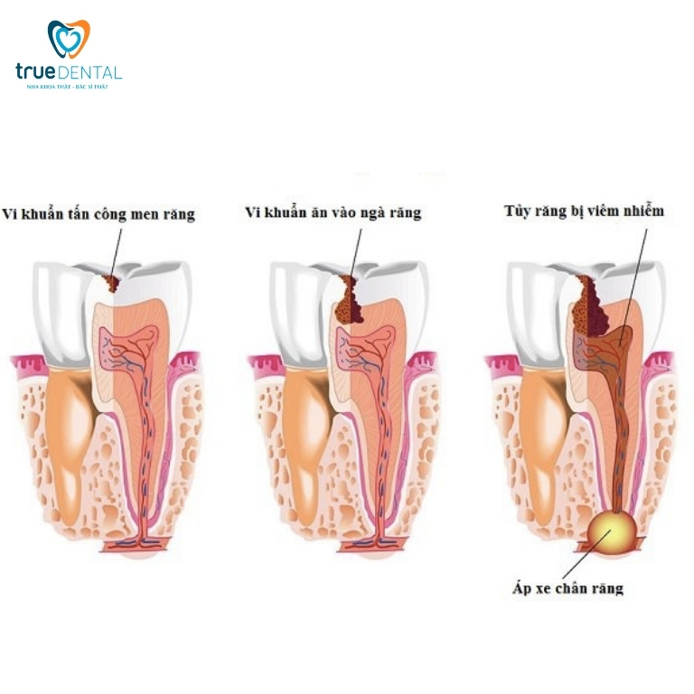 Hoại tử tủy răng: Nguyên nhân, dấu hiệu và cách điều trị 7 Các giai đoạn dẫn đến hoại tử tủy răng