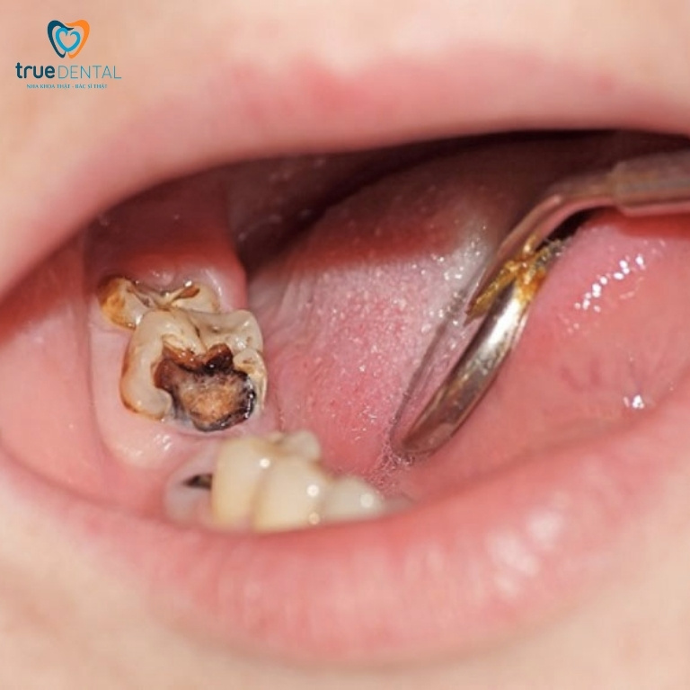 Hoại tử tủy răng: Nguyên nhân, dấu hiệu và cách điều trị 1 Hoại tử tủy răng là gì?