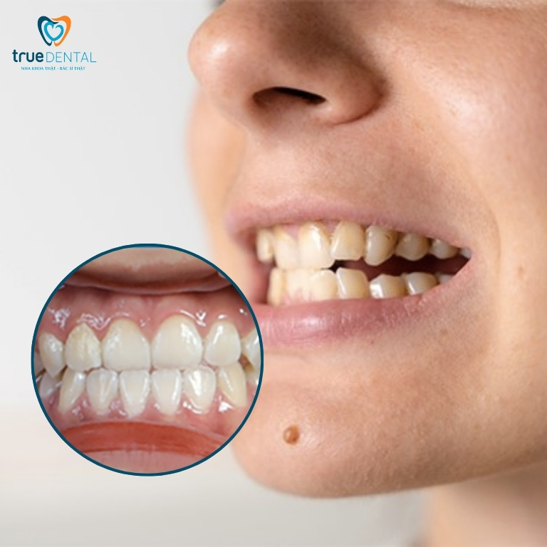 Thế nào là khớp cắn đối đầu? Điều trị bằng cách nào? 1 Khớp cắn đối đầu là gì?