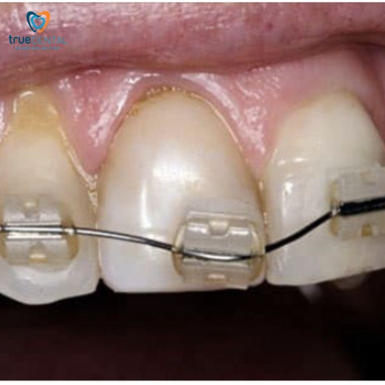 Mắc Cài Bị Lung Lay: Dấu Hiệu Cảnh Báo Bạn Không Nên Bỏ Qua! 3 Mắc cài bị lung lay có nguy hiểm không?