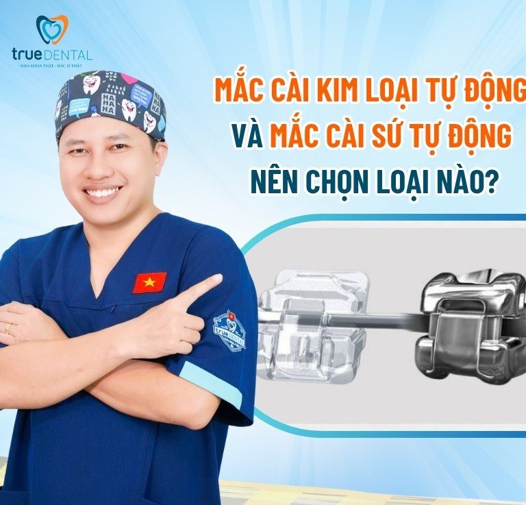 Từ A-Z Về Mắc Cài Tự Động: Chọn Sao Cho Đúng? 6 Mắc cài kim loại tự động và mắc cài sứ tự động: Nên chọn loại nào?