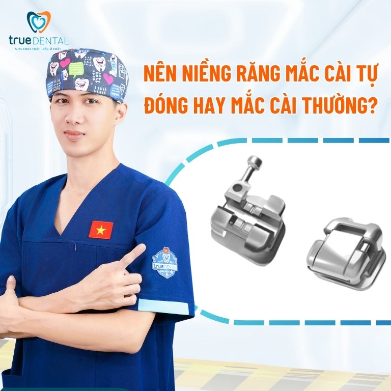Mắc Cài Tự Đóng hay Mắc Cài Thường – Lựa Chọn Nào Tốt Hơn? 4 Nên niềng răng mắc cài tự đóng hay mắc cài thường?