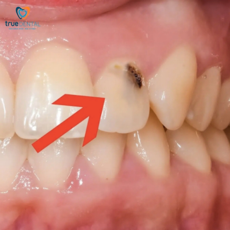 Răng có vết đen: Nguyên nhân, cách chữa trị và phòng ngừa 1 Răng có vết đen là gì?