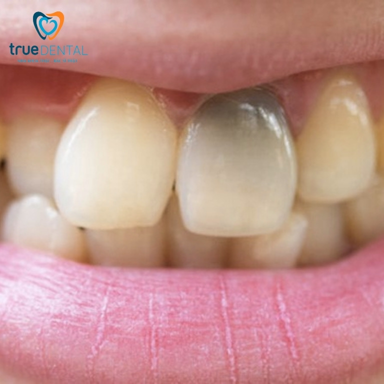 Răng có vết đen: Nguyên nhân, cách chữa trị và phòng ngừa 7 Vết đen trên răng cửa